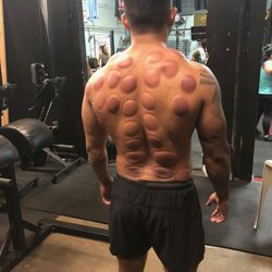 High Performance Therapy - Crossfit athlete preparing for competition, getting a myofascial release, cupping therapy and vibration therapy!