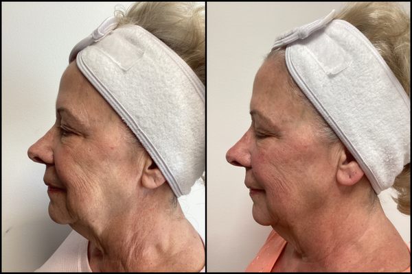 Emface - EmfaceEMFACE is the first and only needle-free, hands-free procedure that simultaneously treats facial skin and muscles in a 20-minute session. EMFACE utilizes the simultaneous application of Synchronized RF and HIFES™ technologies to affect facial skin, muscles, and connective tissue. The end result is less wrinkles, more lift, naturally and without needles. Emface - EmfaceEMFACE is the first and only needle-free, hands-free procedure that simultaneously treats facial skin and muscles in a 20-minute session. EMFACE utilizes the simultaneous application of Synchronized RF and HIFES™ technologies to affect facial skin, muscles, and connective tissue. The end result is less wrinkles, more lift, naturally and without needles.