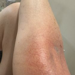 Apex Dermatology - Elbow
