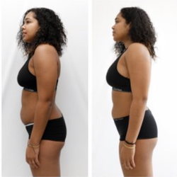 California Aesthetics & Medical Spa - Client had slimming procedure