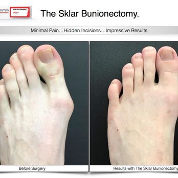 Foot First Podiatry Center PC - We just don't fix feet beautifully, we also fix feet handsomely. Check out www.footfirst.com for more info about our bunion results. - Podiatrists Near Me - Moline, Illinois Foot First Podiatry Center PC - We just don't fix feet beautifully, we also fix feet handsomely. Check out www.footfirst.com for more info about our bunion results. - Podiatrists Near Me - Moline, Illinois