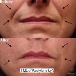 Buffalo Aesthetics - Filler to Nasolabial Folds and Marionette Lines