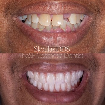 Skoulas, DDS - Before and After - Cosmetic Dentists Near Me - San Francisco, California Skoulas, DDS - Before and After - Cosmetic Dentists Near Me - San Francisco, California