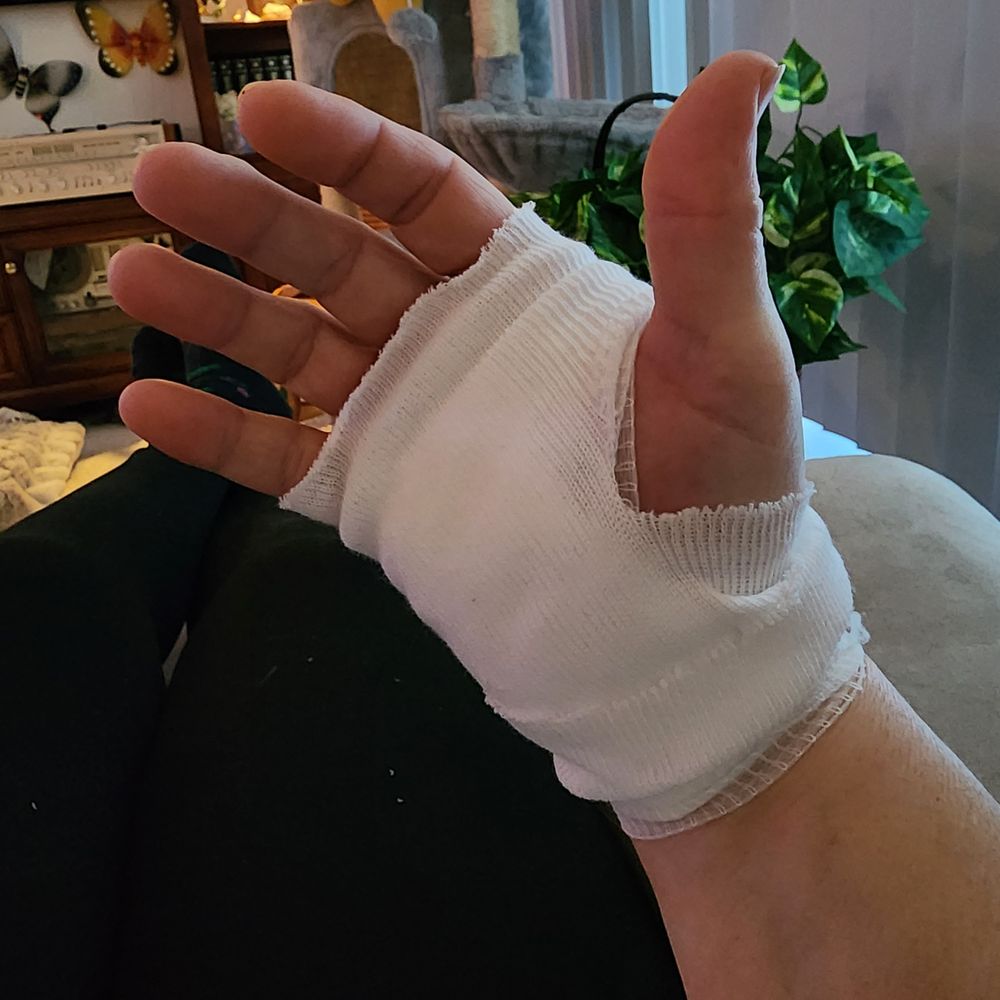 The Hale Hand Center - Right hand done in March... Therapy began the following day! - Physical Therapy Near Me - Melbourne, Florida The Hale Hand Center - Right hand done in March... Therapy began the following day! - Physical Therapy Near Me - Melbourne, Florida