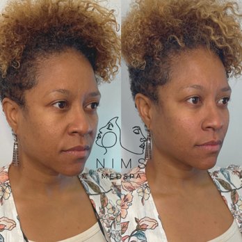NIMS Medspa - Laugh line filler - Skin Care Near Me - Houston, Texas NIMS Medspa - Laugh line filler - Skin Care Near Me - Houston, Texas