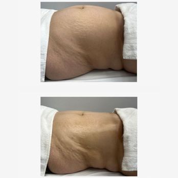 Truly Snatched Body Contouring - While diet & exercise can lead to overall fat loss, they can't selectively target specific areas of stubborn fat we have treatments for that - Body Contouring Near Me - Pasadena, California