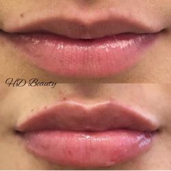 HD Beauty - RHA Lip filler