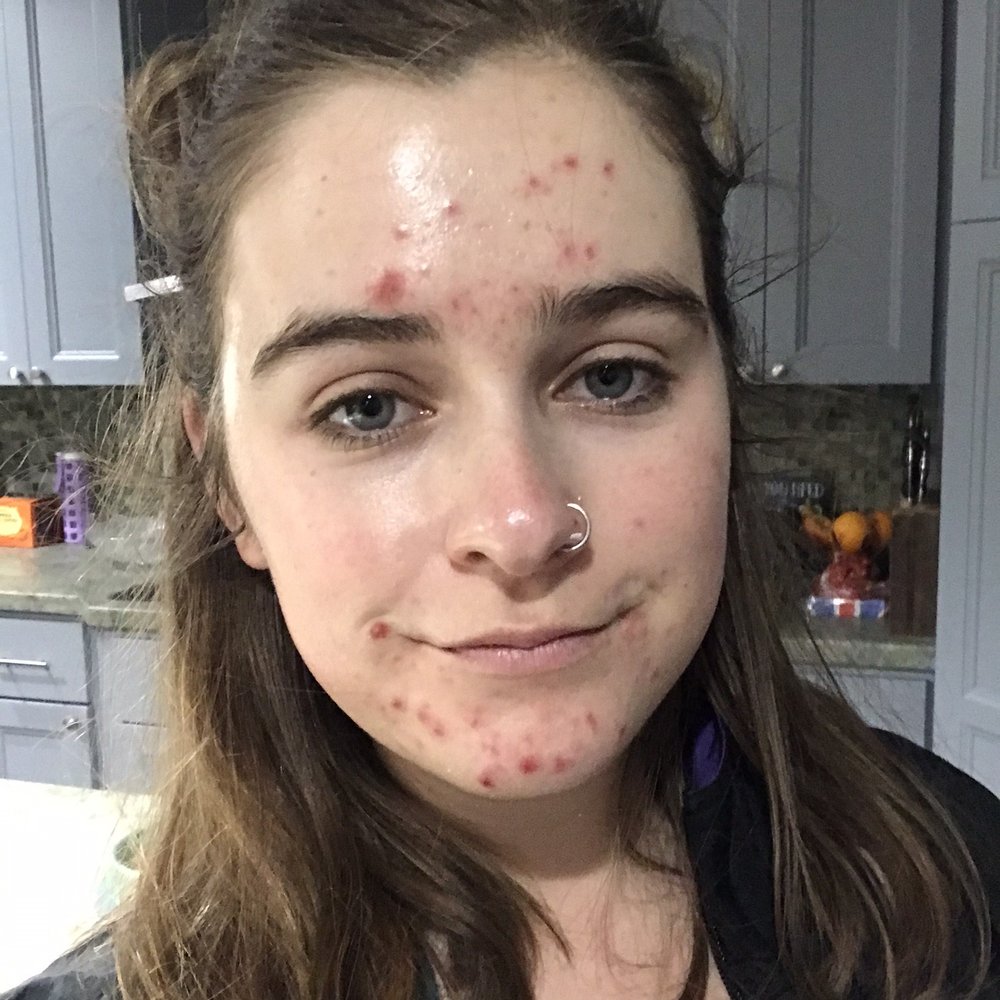 Me post treatment and not as red as I thought I'd be!!! My pimples are on their way to heal Me post treatment and not as red as I thought I'd be!!! My pimples are on their way to heal