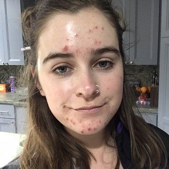 Timelessbeauti - Me post treatment and not as red as I thought I'd be!!! My pimples are on their way to heal - Makeup Artists Near Me Timelessbeauti - Me post treatment and not as red as I thought I'd be!!! My pimples are on their way to heal - Makeup Artists Near Me