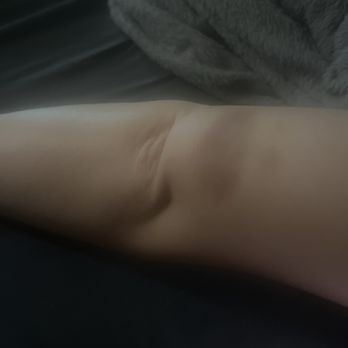Longlife Wellness Spa - Bruised arm - Massage Therapy Near Me - Lake Mary, Florida Longlife Wellness Spa - Bruised arm - Massage Therapy Near Me - Lake Mary, Florida