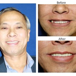 Uptown Cosmetic & Implant Dentistry - Before and After Results from Dr. Velasco's All-On-Four Dental Implant procedure.