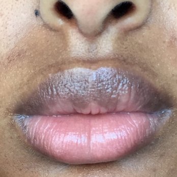 StudioMD - I was BURNED ON MY FACE after my technician left I tried to give this place a second chance and this is what happens. DONT GO HERE ! - Laser Hair Removal Near Me - New York, New York