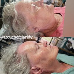 A Touch of Claridy - Cold Plasma Treatment tightens and brightens. Picture after 3rd treatment.
