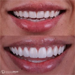 Draper Smiles - Smile Makeover with Composite Bonding Veneers and Invisalign