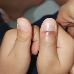 TGA TENNIS - Bruised right thumb after being hit by thick roller foam swung by one the coaches. My son couldn't bend his thumb anymore afterwards.