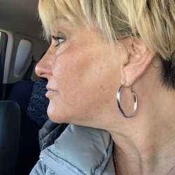 Vicki's Making Faces - After pic of the strawberry laser face lift