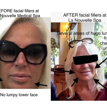 La Nouvelle Medical Spa - Pics of my face before and after the facial fillers - Medical Spas Near Me - Oxnard, California
