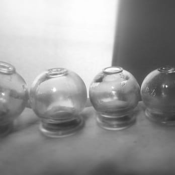 Gaia Acupuncture - Cupping all time favorite - Acupuncture Near Me - Bloomington, Illinois Gaia Acupuncture - Cupping all time favorite - Acupuncture Near Me - Bloomington, Illinois