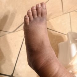 Family HealthCare Network - In treated foot that the health care providers are not helping with