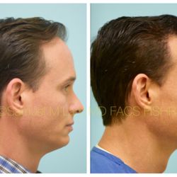 Lam Institute for Hair Restoration - This 43-year-old man is shown before and 10 months after hair transplant.