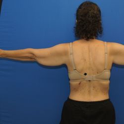 Neal D Goldberg, MD FACS - Arm reduction: before