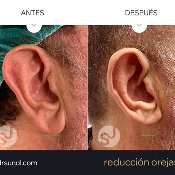 Dr. Joaquim Suñol - Ear Reduction - Macrotia - Cosmetic Surgeons Near Me - Barcelona, B