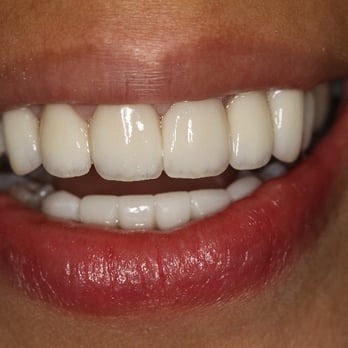 Stanley J Boyd, DMD - After four visits she could smile with confidence - General Dentistry Near Me - New York, New York Stanley J Boyd, DMD - After four visits she could smile with confidence - General Dentistry Near Me - New York, New York
