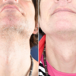 Electrolysis by Rue