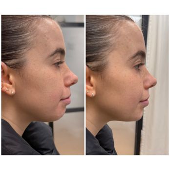 Highline Aesthetics - Facial Balancing filler for the chin to enhance and harmonize her profile. - Medical Spas Near Me - Denver, Colorado Highline Aesthetics - Facial Balancing filler for the chin to enhance and harmonize her profile. - Medical Spas Near Me - Denver, Colorado