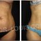 Atlanta Liposuction Specialty Clinic