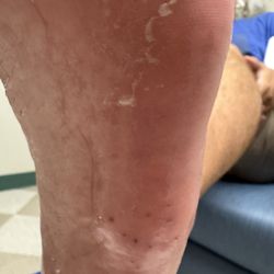 Sun Dermatology - Sea urchin spines aka: porcupine of the sea