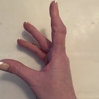 Swift Institute Hand Therapy - Getting there, it's straight! - Occupational Therapy Near Me - Reno, Nevada Swift Institute Hand Therapy - Getting there, it's straight! - Occupational Therapy Near Me - Reno, Nevada
