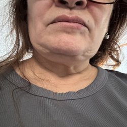 Premiere Center for Cosmetic Surgery - Under my chin after a neck lift worth Dr Hess