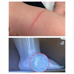 Premier ER & Urgent Care - Woodway - The red mark used to create drama & X-ray of actual fractures that were ignored.