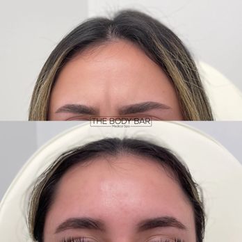 The Body Bar - Forehead tox - Medical Spas Near Me - Corona, California The Body Bar - Forehead tox - Medical Spas Near Me - Corona, California