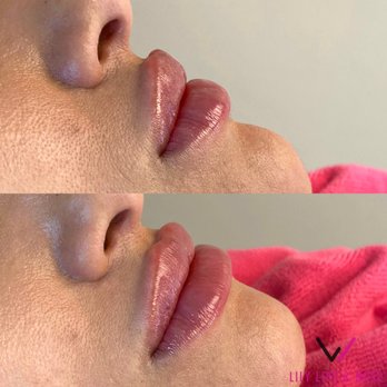 Lily Lips & Nose - Medical Spas Near Me - Miami, Florida Lily Lips & Nose - Medical Spas Near Me - Miami, Florida