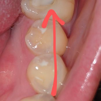 Michael L Eisenbrock, DDS - Evidence of a root canaled molar drilled by him which was fixed by another dentist. - Cosmetic Dentists Near Me - Bensalem, Pennsylvania Michael L Eisenbrock, DDS - Evidence of a root canaled molar drilled by him which was fixed by another dentist. - Cosmetic Dentists Near Me - Bensalem, Pennsylvania