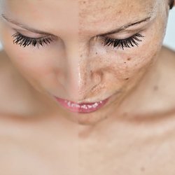 Aesthetica Skin Health & Wellness - IPL - Minimize pigment, sun damage, freckles & age spots. Reduce capillaries & redness. Refresh & rejuvinate your skin.