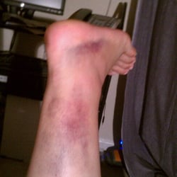 Nguyen Ky, DPM - Fractured Tibia.