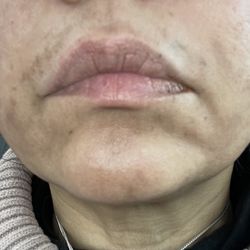 After peel