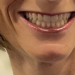 Orthodontic Specialists Of St. Louis - New Smile with Invisalign! Thank you OSSTL!!