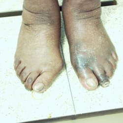Foot and Ankle Institute of NC - Bunion correction done right.