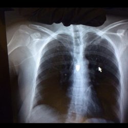Centro Medico - This is proof I'm paralyzed. The bullet before it was removed a year ago