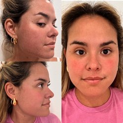 Cutella Medical Spa - Halo Downtime