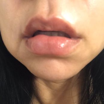 Everything Esthetics - After lip filler - Permanent Makeup Near Me - Sacramento, California