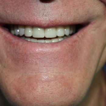 Pine Plaza Dental - Full mouth smile makeover with Zirconia crowns - Cosmetic Dentists Near Me - Las Vegas, Nevada Pine Plaza Dental - Full mouth smile makeover with Zirconia crowns - Cosmetic Dentists Near Me - Las Vegas, Nevada