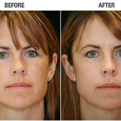 New Age Laser Aesthetics - We successfully treat dark spots from sun damage and freckles!