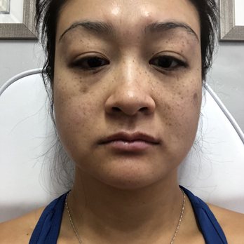 Glam MedSpa - Before Botox. Even though I'm not smiling, my face is sagging and I look extremely tired. - Medical Spas Near Me - Mesa, Arizona Glam MedSpa - Before Botox. Even though I'm not smiling, my face is sagging and I look extremely tired. - Medical Spas Near Me - Mesa, Arizona