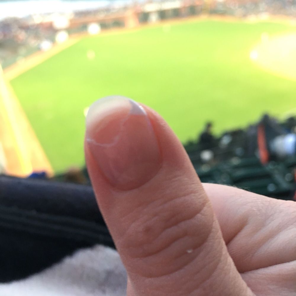 Coco Nails Spa - My thumb nail completely stripped off. - Nail Salons Near Me - Lincoln, California Coco Nails Spa - My thumb nail completely stripped off. - Nail Salons Near Me - Lincoln, California