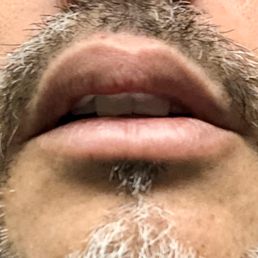 Swollen mouth after treatment. Swollen mouth after treatment.
